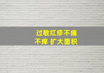 过敏红疹不痛不痒 扩大面积